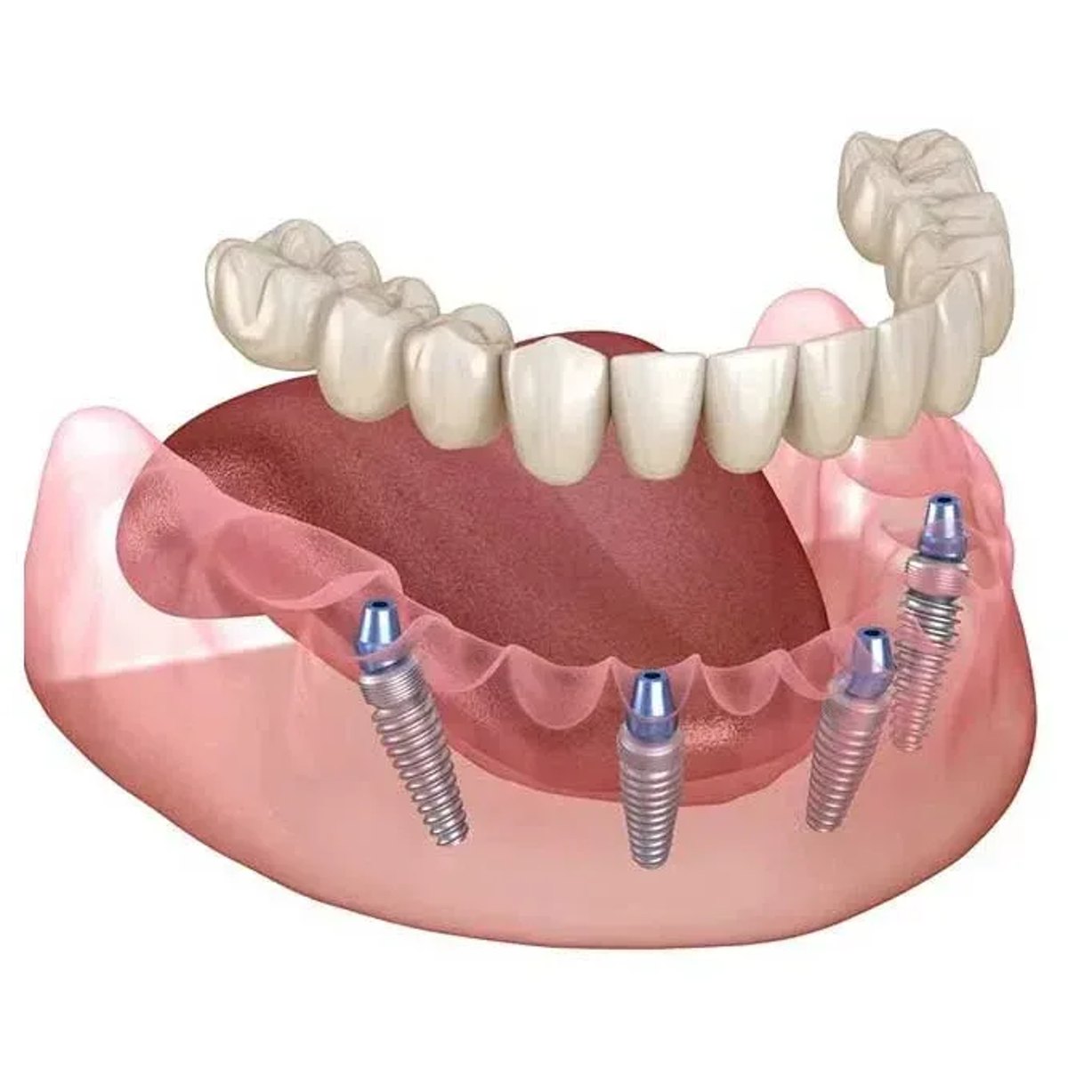 All-on-4 full mouth dental implants
