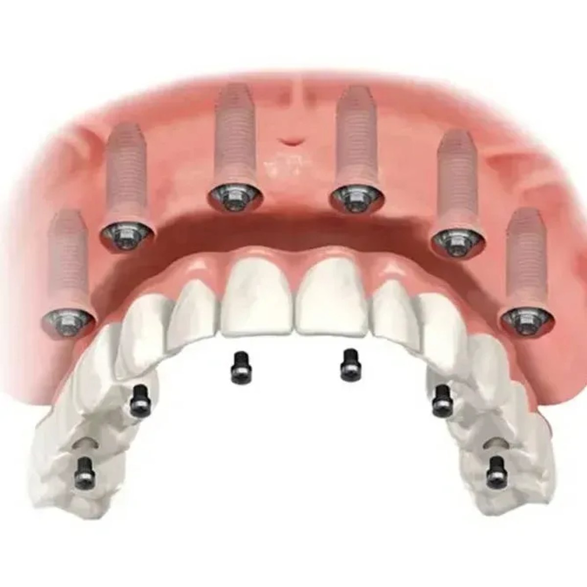 All-on-6 full mouth dental implants
