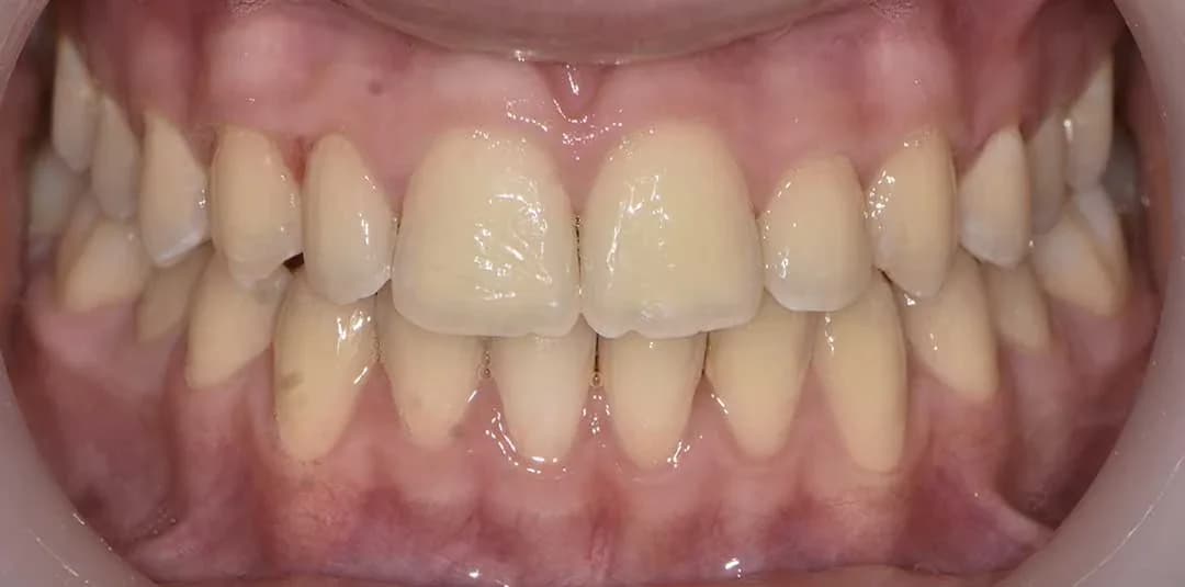 Invisalign dubai