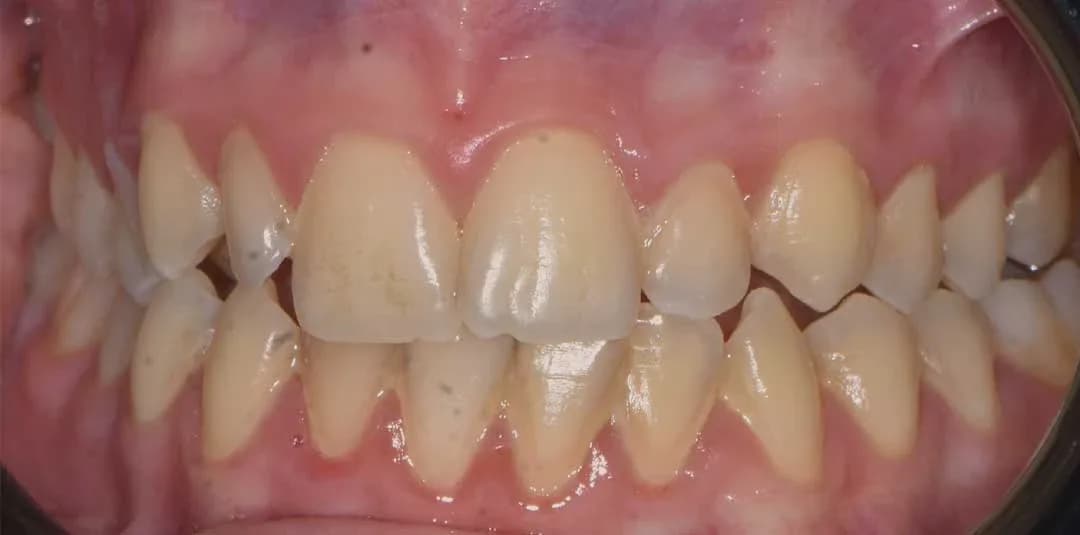 Invisalign dubai