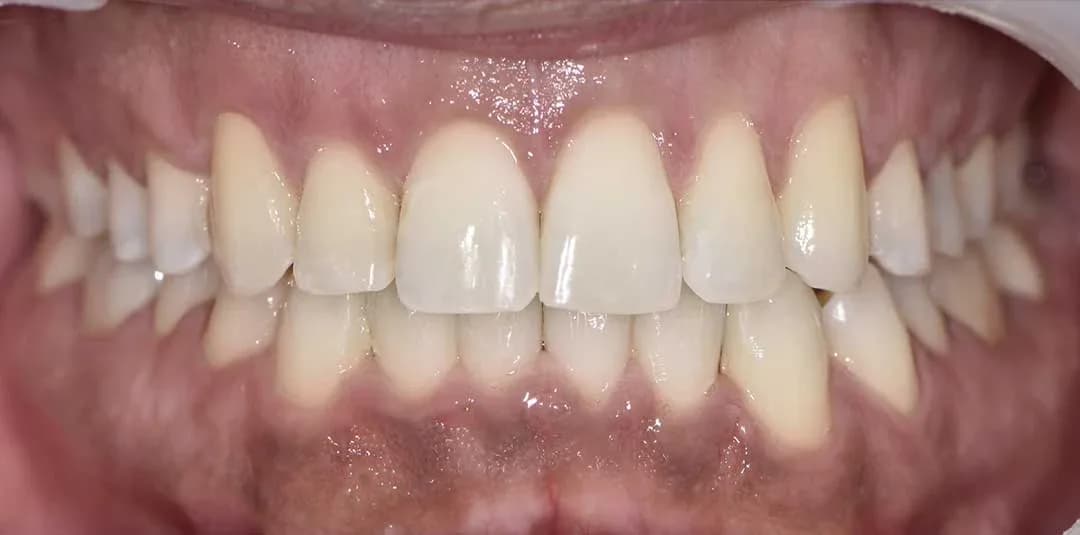 Invisalign Treatment in Dubai