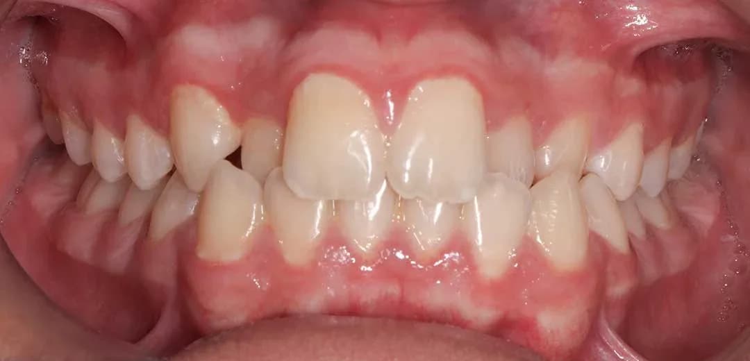 Invisalign in Dubai – 50% OFF at Harmony Medical Center, Jumeirah