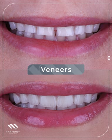 Composite veneers smile makeover result at Harmony Medical Center Jumeirah Dubai