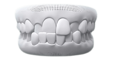 Overbite case photo
