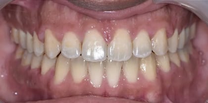 Invisalign after — Dr. Iyad Al Samman at Harmony Medical Center Jumeirah Dubai