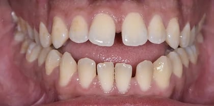 Invisalign before — Dr. Iyad Al Samman at Harmony Medical Center Jumeirah Dubai