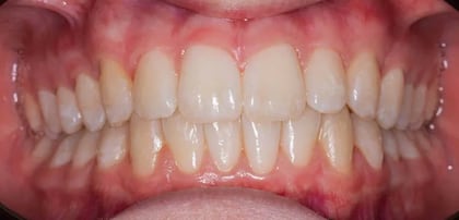 Invisalign after — Dr. Najwana Attisha at Harmony Medical Center Jumeirah Dubai