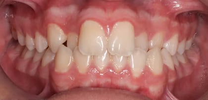 Invisalign before — Dr. Najwana Attisha at Harmony Medical Center Jumeirah Dubai
