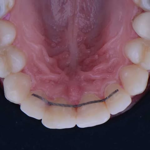Fixed retainer behind the front teeth