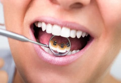Lingual braces fitted behind the teeth