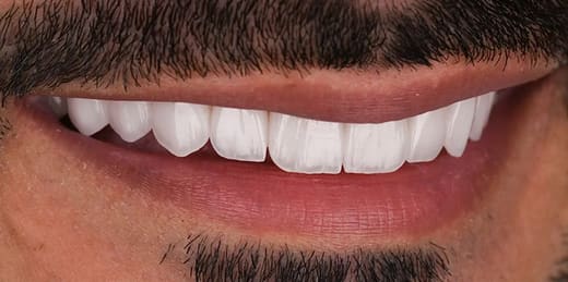 Before veneers treatment