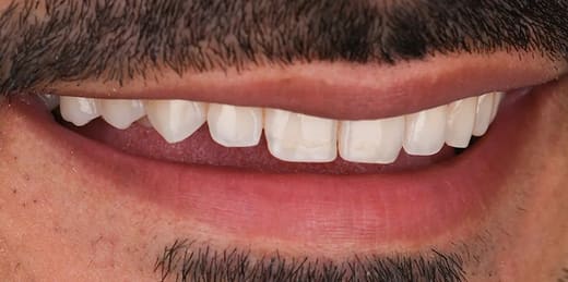 After veneers treatment