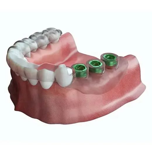 Ceramic (Zirconia) Implants
