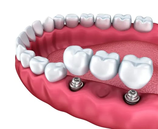 Multiple Tooth Implants / Implant Bridge