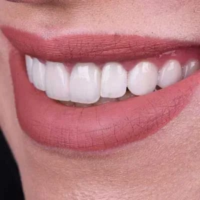 Smile Makeovers