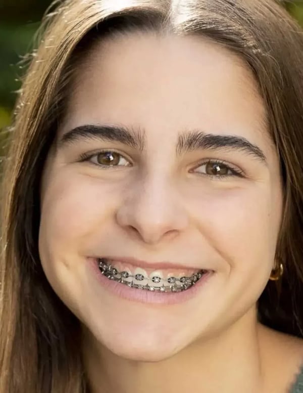 Damon Braces