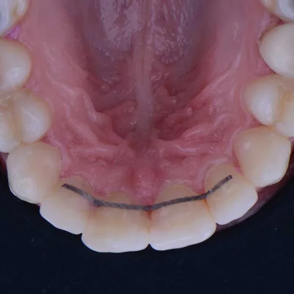 Retainers