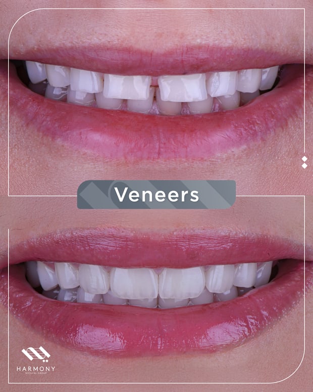 Composite veneers procedure at Harmony Medical Center Jumeirah Dubai — before and after smile makeover