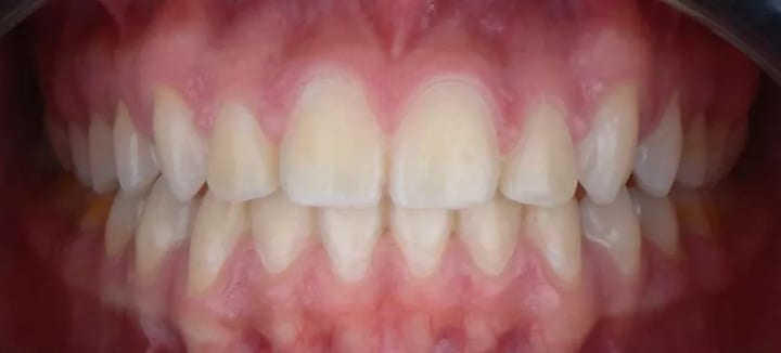 After comparison, braces case 2