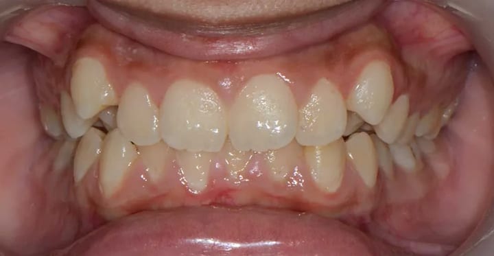 Before comparison, braces case 3