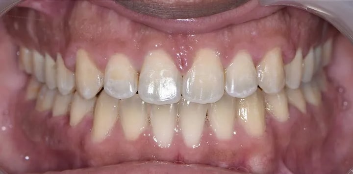 clear aligners near me