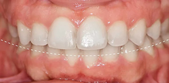 clear aligners abu dhabi
