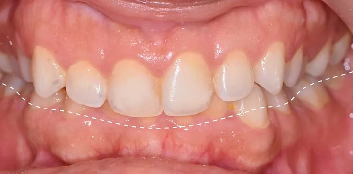clear aligners abu dhabi