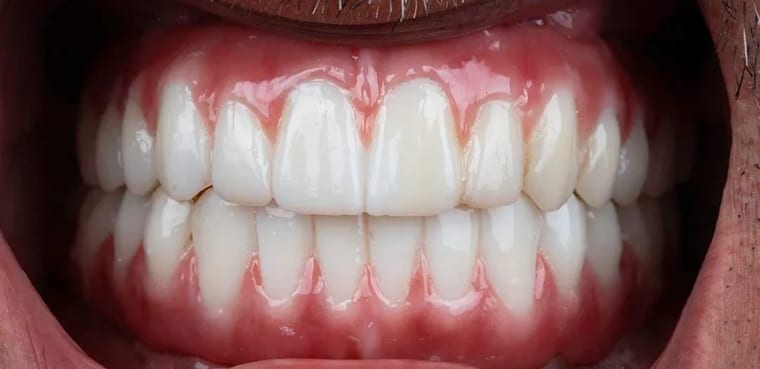 After dental implants