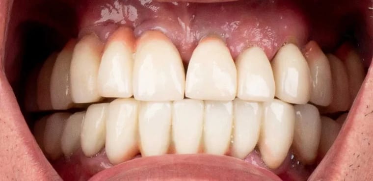Before dental implants