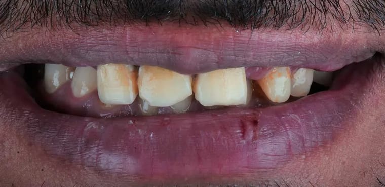 Before dental implants