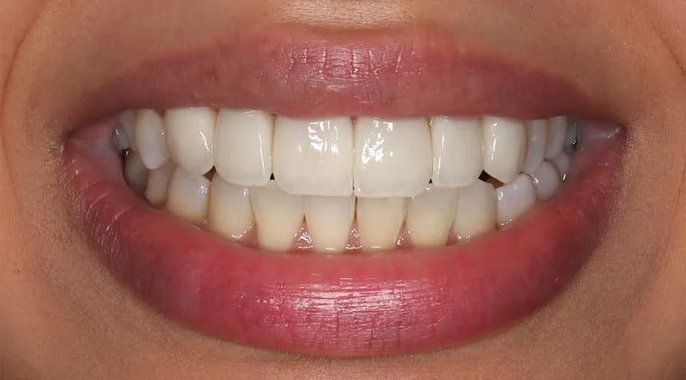 After dental crown treatment