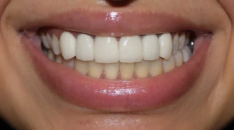 Before dental crown treatment