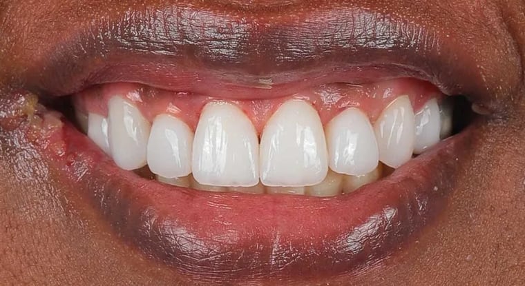 After dental crown treatment