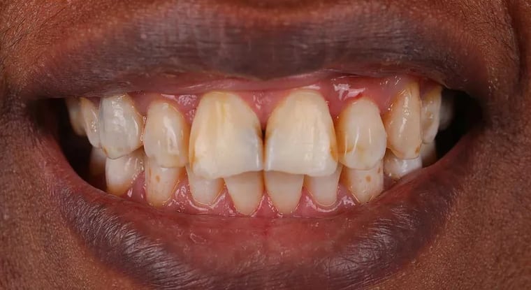 Before dental crown treatment