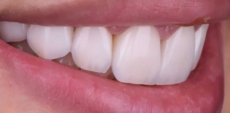After dental crown treatment
