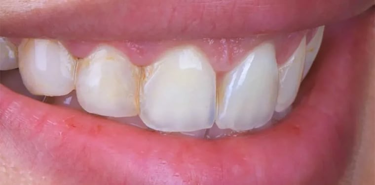 Before dental crown treatment