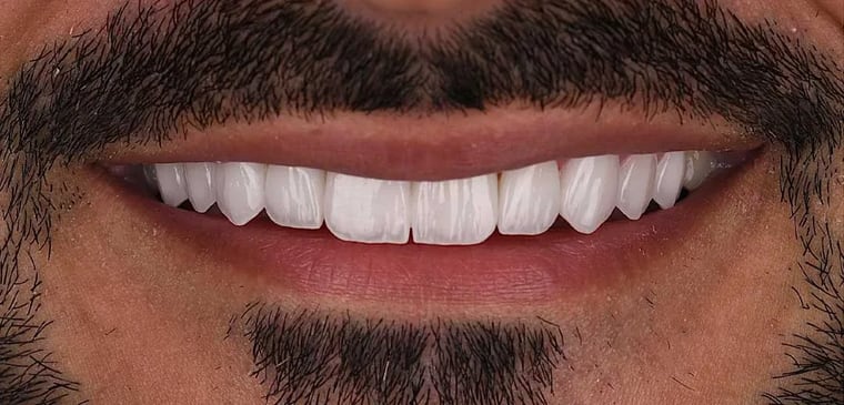 After dental crown treatment