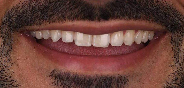 Before dental crown treatment