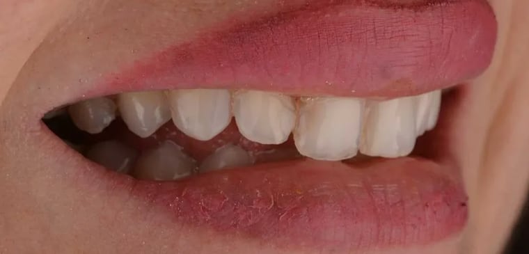 Before veneers treatment