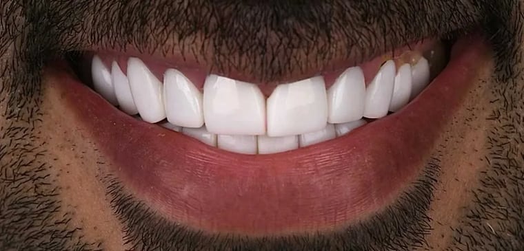 Before veneers treatment