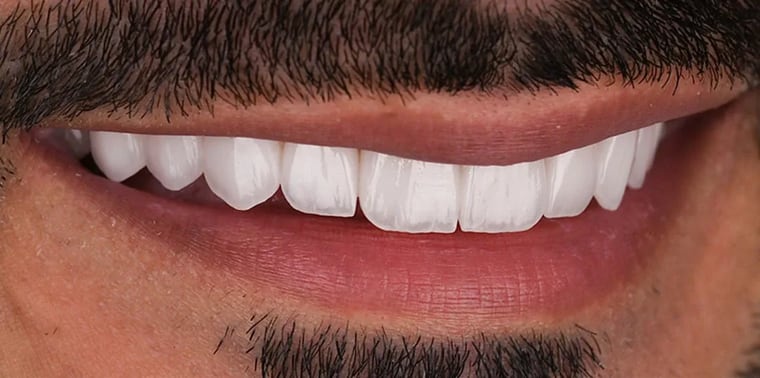 Before veneers treatment