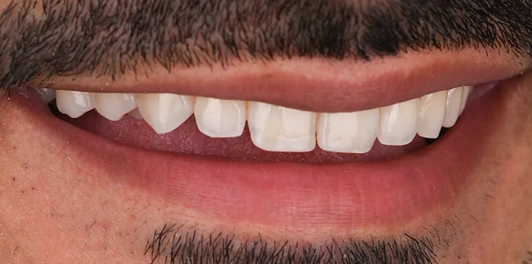 After veneers treatment