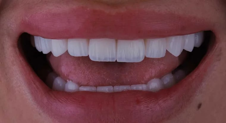 After dental crown treatment