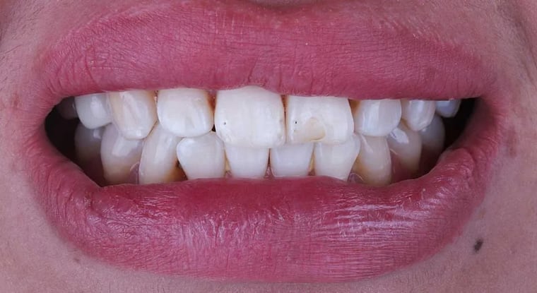 Before dental crown treatment