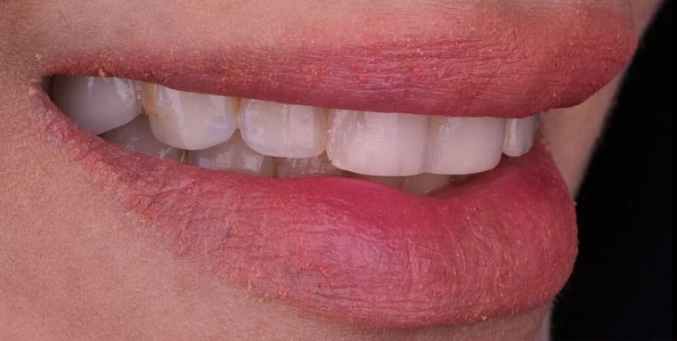 Before dental crown treatment
