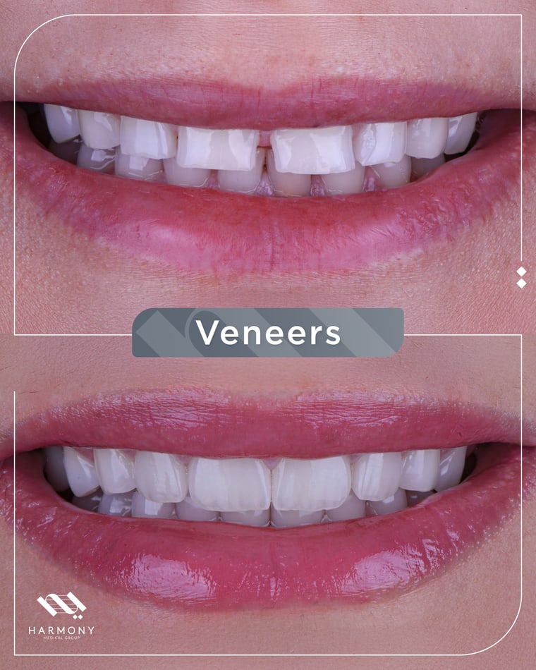 Procedure for getting veneers in Dubai at Harmony