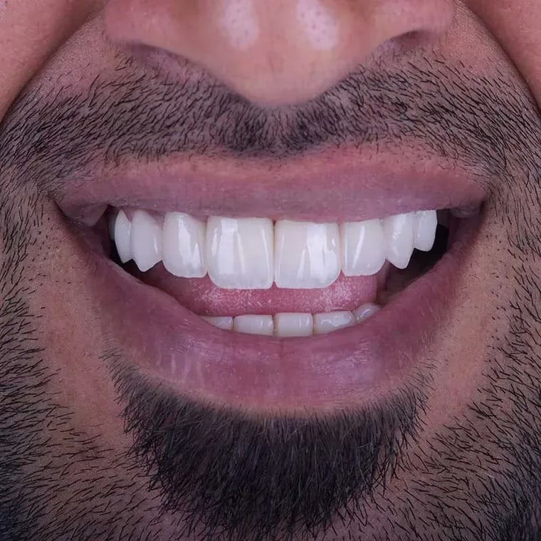 Dental crown indications: when do you need a crown in Dubai