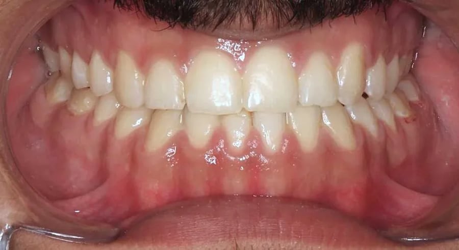 Case 4 after braces treatment in Dubai