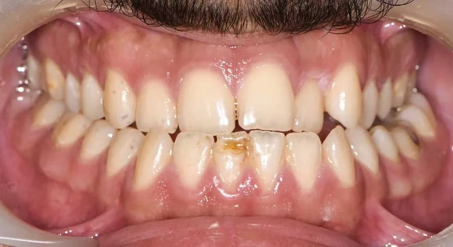 Case 4 before braces treatment in Dubai