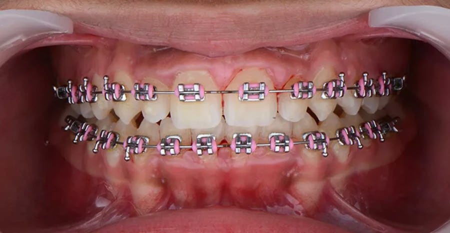Case 1 after braces treatment in Dubai